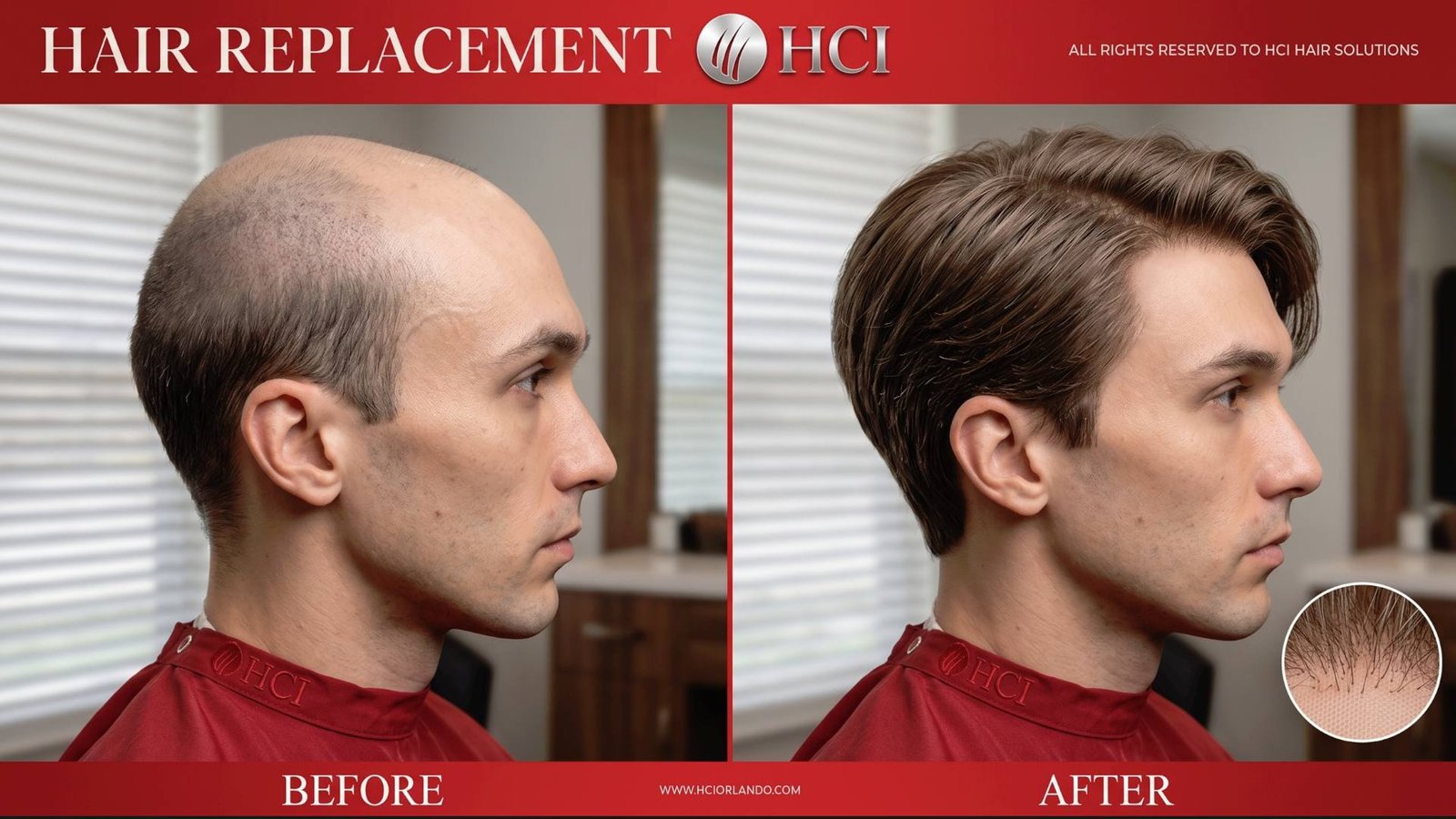 Orlando Hair Transplant Restoration - HCI Hair Solutions