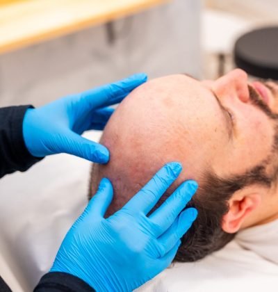 Doctor specialist in baldness checking a patient with hair loss
